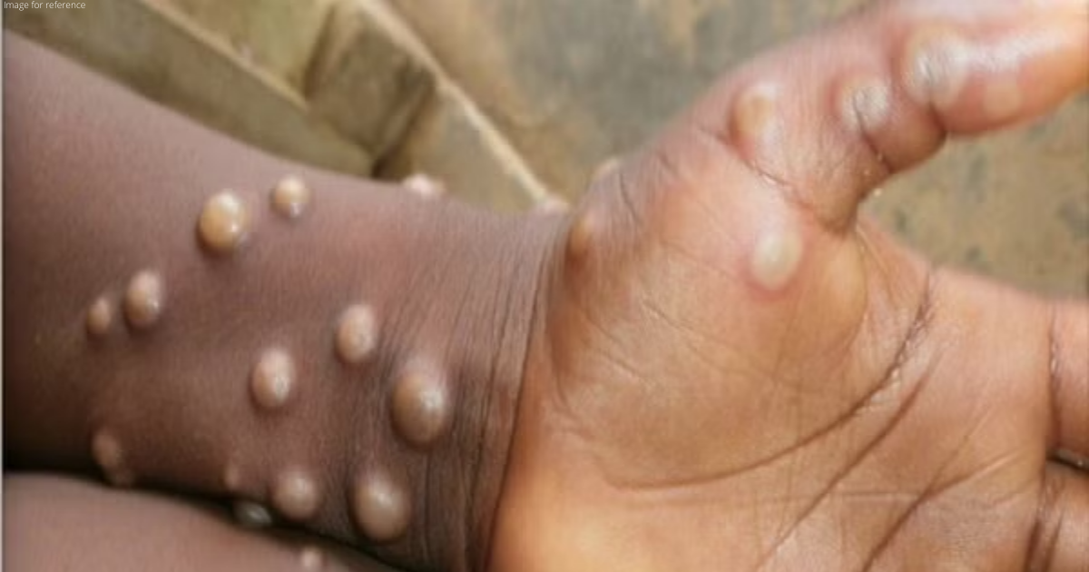 Delhi reports 4th Monkeypox case, India tally goes up to 9